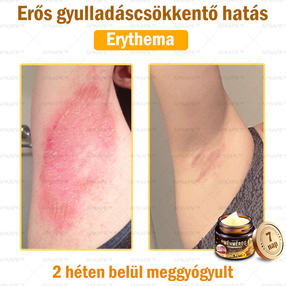 𝐀𝐏𝐊𝐀𝐏𝐊™ 𝐌é𝐡𝐦é𝐫𝐞𝐠 𝐁ő𝐫𝐫𝐞𝐠𝐞𝐧𝐞𝐫á𝐥ó 𝐊𝐫é𝐦 🧑‍⚕️ 🧑‍⚕️𝐀 𝐛ő𝐫𝐩𝐫𝐨𝐛𝐥é𝐦á𝐤 𝐤𝐞𝐳𝐞𝐥é𝐬𝐞 𝐦𝐚𝐠á𝐛𝐚𝐧 𝐟𝐨𝐠𝐥𝐚𝐥𝐣𝐚: é𝐥𝐞𝐭𝐤𝐨𝐫𝐢 𝐟𝐨𝐥𝐭𝐨𝐤, 𝐡𝐞𝐠𝐞𝐤, 𝐬𝐳𝐞𝐦ö𝐥𝐜𝐬ö𝐤, 𝐛ő𝐫𝐧ö𝐯𝐞𝐝é𝐤𝐞𝐤, 𝐭á𝐥𝐲𝐨𝐠𝐨𝐤, 𝐩𝐚𝐭𝐭𝐚𝐧á𝐬𝐨𝐤, 𝐞𝐤𝐜é𝐦𝐚, 𝐩𝐬𝐨𝐫𝐢𝐚𝐬𝐢𝐬, 𝐚𝐜𝐧𝐞 𝐢𝐧𝐯𝐞𝐫𝐬𝐚, 𝐫á𝐧𝐜𝐨𝐤, 𝐛ő𝐫ö𝐫𝐞𝐠𝐞𝐝é𝐬 é𝐬 𝐞𝐠𝐲é𝐛 𝐩𝐫𝐨𝐛𝐥é𝐦á𝐤 🔥