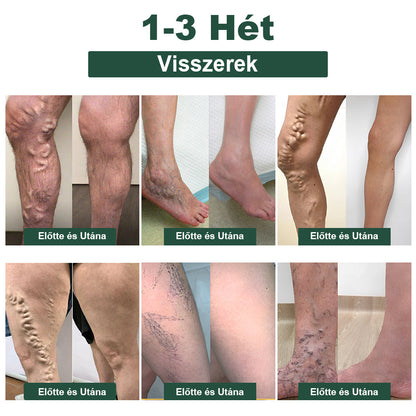 𝐁𝐞𝐧𝐞𝐭𝐮𝐫𝐞™ Méhméreg karcsúsító nyirokcsomó méregtelenítő gyulladáscsökkentő fájdalomcsillapító lábáztató gyöngyök - Mayo Clinic Recommended (több mint 2 millió fogyasztó bízik benne világszerte)