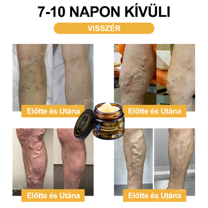 ZVLZVL™🍯Méhméreg Azonnali Ultra Erős Fájdalomcsillapító Krém -❄ Új téli akció | ❄ Akár 70% kedvezmény