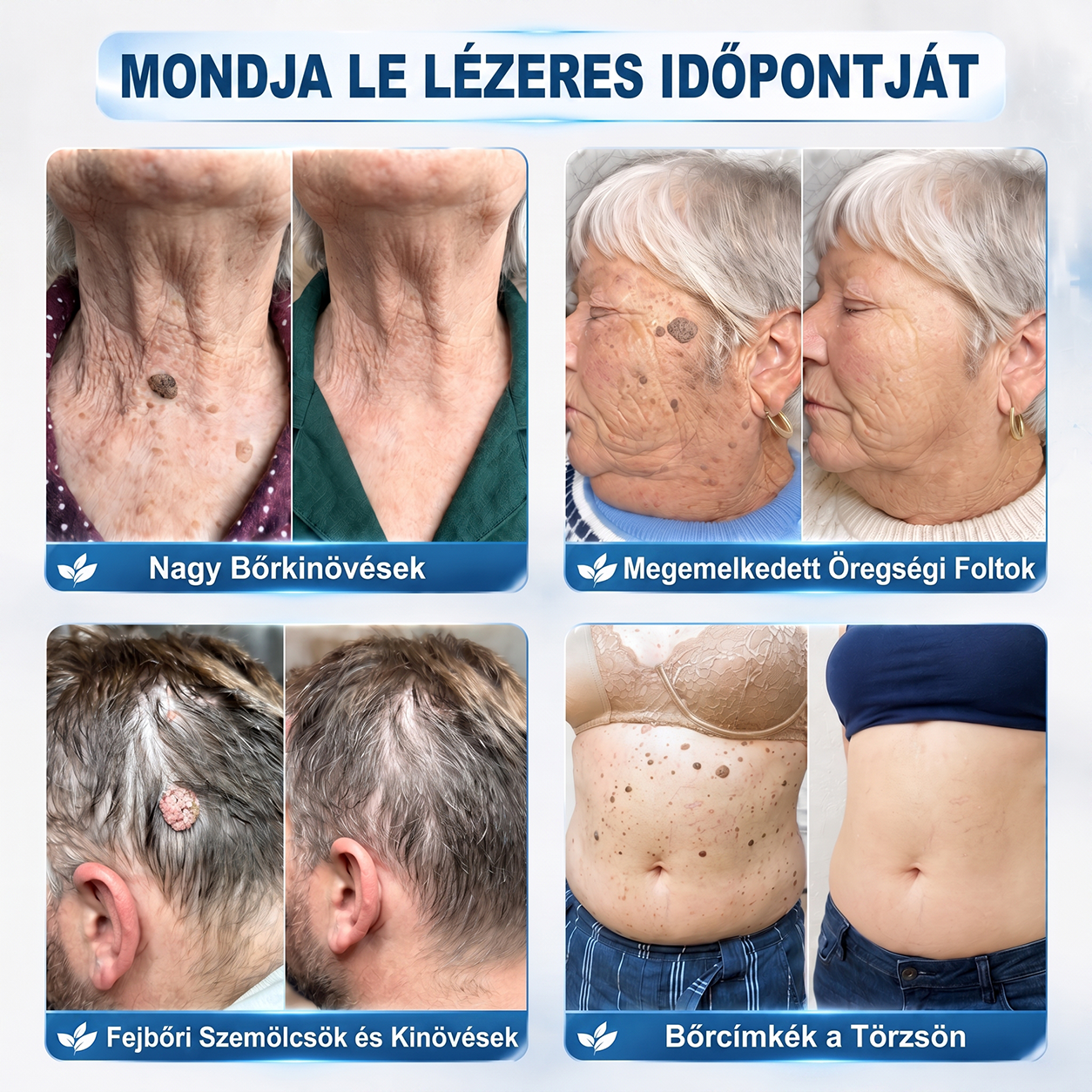 🔥Hivatalos Márkabolt | 🚢🚢 Hiskin® 7 napos Szemölcseltávolító Roll-on Ápoló Folyadék (Fájdalommentes rollerball technológia, hegek nélkül)