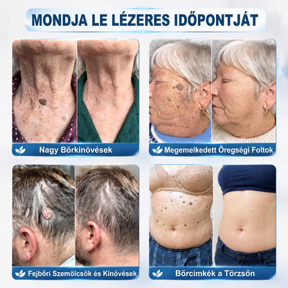 🔥Hivatalos Márkabolt | 🚢🚢 Hiskin® 7 napos Szemölcseltávolító Roll-on Ápoló Folyadék (Fájdalommentes rollerball technológia, hegek nélkül)