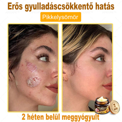 𝐀𝐏𝐊𝐀𝐏𝐊™ 𝐌é𝐡𝐦é𝐫𝐞𝐠 𝐁ő𝐫𝐫𝐞𝐠𝐞𝐧𝐞𝐫á𝐥ó 𝐊𝐫é𝐦 🧑‍⚕️ 🧑‍⚕️𝐀 𝐛ő𝐫𝐩𝐫𝐨𝐛𝐥é𝐦á𝐤 𝐤𝐞𝐳𝐞𝐥é𝐬𝐞 𝐦𝐚𝐠á𝐛𝐚𝐧 𝐟𝐨𝐠𝐥𝐚𝐥𝐣𝐚: é𝐥𝐞𝐭𝐤𝐨𝐫𝐢 𝐟𝐨𝐥𝐭𝐨𝐤, 𝐡𝐞𝐠𝐞𝐤, 𝐬𝐳𝐞𝐦ö𝐥𝐜𝐬ö𝐤, 𝐛ő𝐫𝐧ö𝐯𝐞𝐝é𝐤𝐞𝐤, 𝐭á𝐥𝐲𝐨𝐠𝐨𝐤, 𝐩𝐚𝐭𝐭𝐚𝐧á𝐬𝐨𝐤, 𝐞𝐤𝐜é𝐦𝐚, 𝐩𝐬𝐨𝐫𝐢𝐚𝐬𝐢𝐬, 𝐚𝐜𝐧𝐞 𝐢𝐧𝐯𝐞𝐫𝐬𝐚, 𝐫á𝐧𝐜𝐨𝐤, 𝐛ő𝐫ö𝐫𝐞𝐠𝐞𝐝é𝐬 é𝐬 𝐞𝐠𝐲é𝐛 𝐩𝐫𝐨𝐛𝐥é𝐦á𝐤 🔥