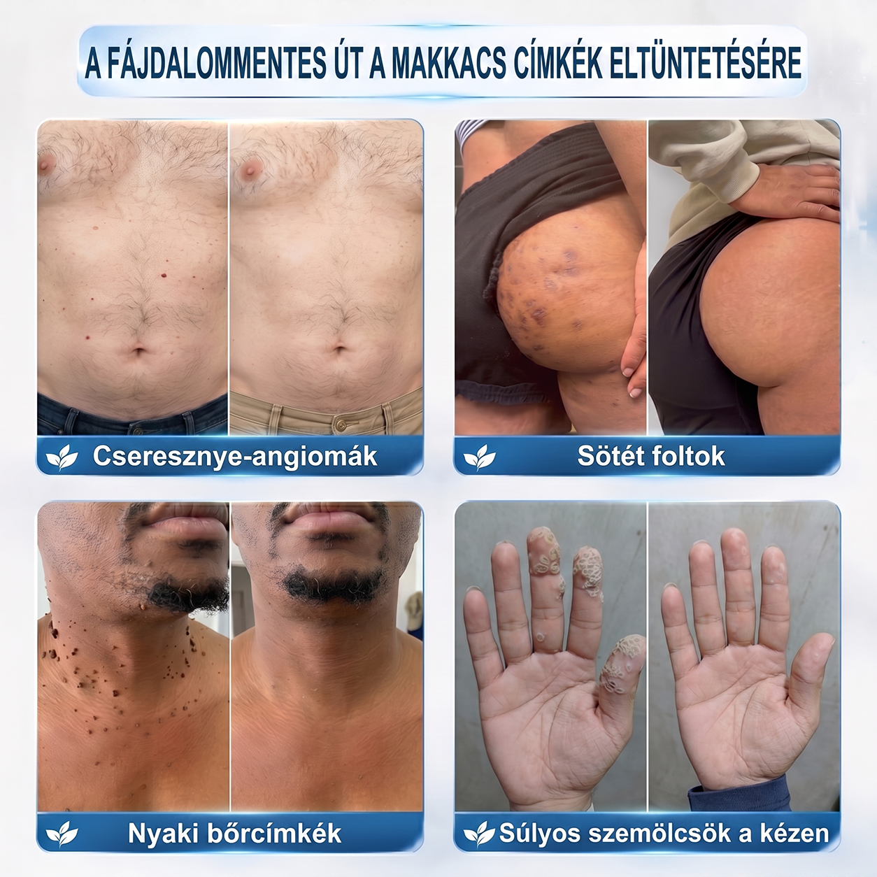 🔥Hivatalos Márkabolt | 🚢🚢 Hiskin® 7 napos Szemölcseltávolító Roll-on Ápoló Folyadék (Fájdalommentes rollerball technológia, hegek nélkül)