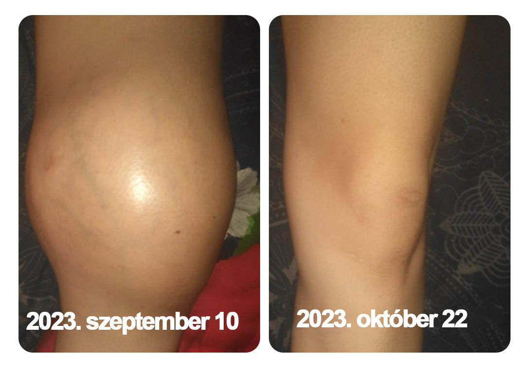 🌿🍯🌿BEARNICA™ Bee Venom Advanced ízület- és csontkezelő krém🔥 (Utolsó napi akció, 70% kedvezmény)