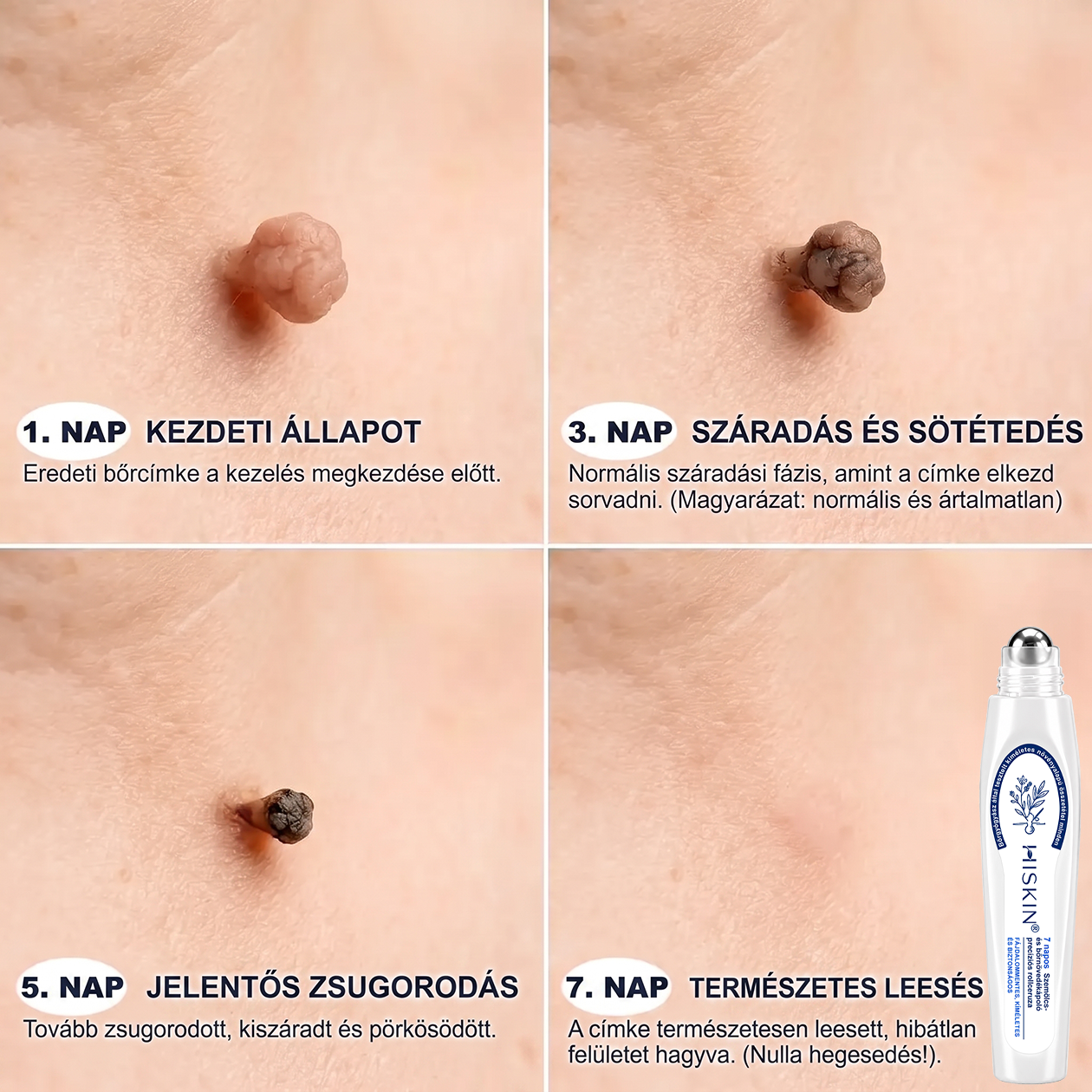 🔥Hivatalos Márkabolt | 🚢🚢 Hiskin® 7 napos Szemölcseltávolító Roll-on Ápoló Folyadék (Fájdalommentes rollerball technológia, hegek nélkül)
