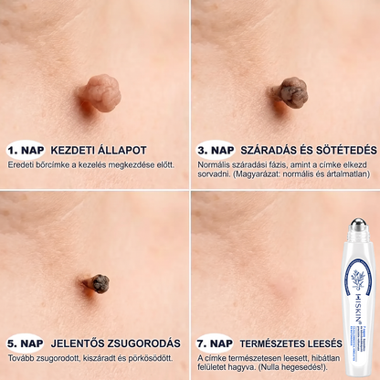 🔥Hivatalos Márkabolt | 🚢🚢 Hiskin® 7 napos Szemölcseltávolító Roll-on Ápoló Folyadék (Fájdalommentes rollerball technológia, hegek nélkül)