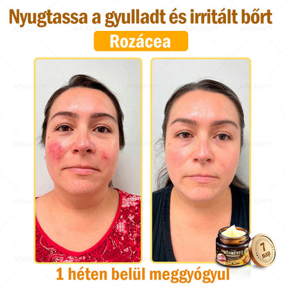 𝐀𝐏𝐊𝐀𝐏𝐊™ 𝐌é𝐡𝐦é𝐫𝐞𝐠 𝐁ő𝐫𝐫𝐞𝐠𝐞𝐧𝐞𝐫á𝐥ó 𝐊𝐫é𝐦 🧑‍⚕️ 🧑‍⚕️𝐀 𝐛ő𝐫𝐩𝐫𝐨𝐛𝐥é𝐦á𝐤 𝐤𝐞𝐳𝐞𝐥é𝐬𝐞 𝐦𝐚𝐠á𝐛𝐚𝐧 𝐟𝐨𝐠𝐥𝐚𝐥𝐣𝐚: é𝐥𝐞𝐭𝐤𝐨𝐫𝐢 𝐟𝐨𝐥𝐭𝐨𝐤, 𝐡𝐞𝐠𝐞𝐤, 𝐬𝐳𝐞𝐦ö𝐥𝐜𝐬ö𝐤, 𝐛ő𝐫𝐧ö𝐯𝐞𝐝é𝐤𝐞𝐤, 𝐭á𝐥𝐲𝐨𝐠𝐨𝐤, 𝐩𝐚𝐭𝐭𝐚𝐧á𝐬𝐨𝐤, 𝐞𝐤𝐜é𝐦𝐚, 𝐩𝐬𝐨𝐫𝐢𝐚𝐬𝐢𝐬, 𝐚𝐜𝐧𝐞 𝐢𝐧𝐯𝐞𝐫𝐬𝐚, 𝐫á𝐧𝐜𝐨𝐤, 𝐛ő𝐫ö𝐫𝐞𝐠𝐞𝐝é𝐬 é𝐬 𝐞𝐠𝐲é𝐛 𝐩𝐫𝐨𝐛𝐥é𝐦á𝐤 🔥