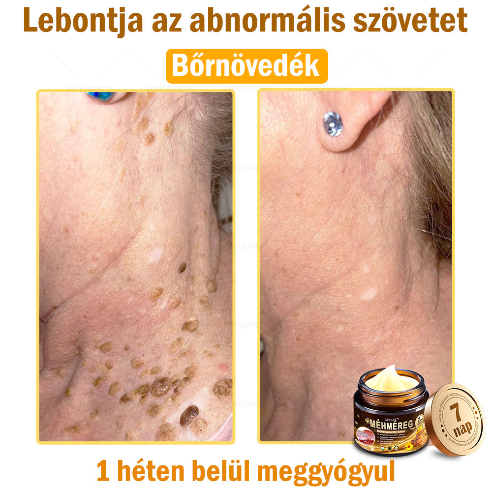 𝐀𝐏𝐊𝐀𝐏𝐊™ 𝐌é𝐡𝐦é𝐫𝐞𝐠 𝐁ő𝐫𝐫𝐞𝐠𝐞𝐧𝐞𝐫á𝐥ó 𝐊𝐫é𝐦 🧑‍⚕️ 🧑‍⚕️𝐀 𝐛ő𝐫𝐩𝐫𝐨𝐛𝐥é𝐦á𝐤 𝐤𝐞𝐳𝐞𝐥é𝐬𝐞 𝐦𝐚𝐠á𝐛𝐚𝐧 𝐟𝐨𝐠𝐥𝐚𝐥𝐣𝐚: é𝐥𝐞𝐭𝐤𝐨𝐫𝐢 𝐟𝐨𝐥𝐭𝐨𝐤, 𝐡𝐞𝐠𝐞𝐤, 𝐬𝐳𝐞𝐦ö𝐥𝐜𝐬ö𝐤, 𝐛ő𝐫𝐧ö𝐯𝐞𝐝é𝐤𝐞𝐤, 𝐭á𝐥𝐲𝐨𝐠𝐨𝐤, 𝐩𝐚𝐭𝐭𝐚𝐧á𝐬𝐨𝐤, 𝐞𝐤𝐜é𝐦𝐚, 𝐩𝐬𝐨𝐫𝐢𝐚𝐬𝐢𝐬, 𝐚𝐜𝐧𝐞 𝐢𝐧𝐯𝐞𝐫𝐬𝐚, 𝐫á𝐧𝐜𝐨𝐤, 𝐛ő𝐫ö𝐫𝐞𝐠𝐞𝐝é𝐬 é𝐬 𝐞𝐠𝐲é𝐛 𝐩𝐫𝐨𝐛𝐥é𝐦á𝐤 🔥