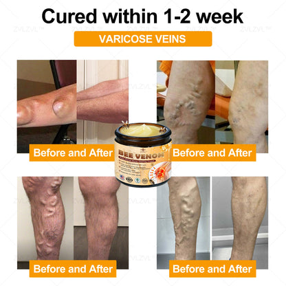 ZVLZVL™ Bee Venom Instant Pain Relief Arthritis Therapy Cream
